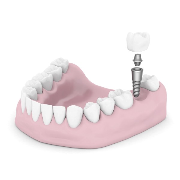 Are You Tired of Wearing Dentures? Try Dental Implants